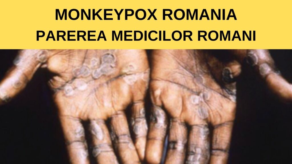 Monkeypox Romania