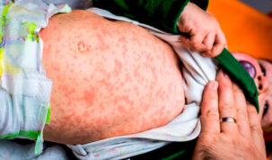 Epidemie naţională! A existat o reticenţă a părinţilor la vaccinul antirujeolă, din cauza antivacciniştilor