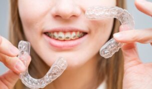 Aparat dentar Spark vs. aparat dentar metalic: care ți se potrivește?